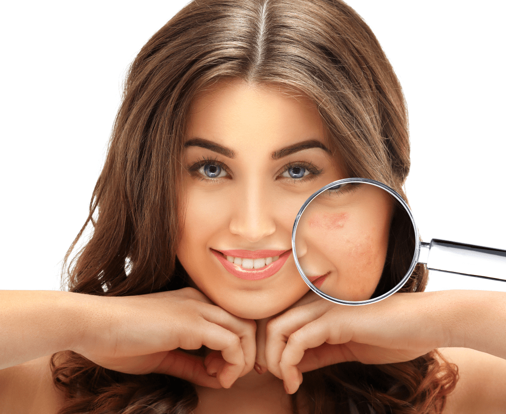 acne scars cost in hyderabad