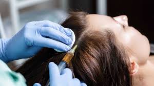 Everything you need to know about PRP Hair Treatment
