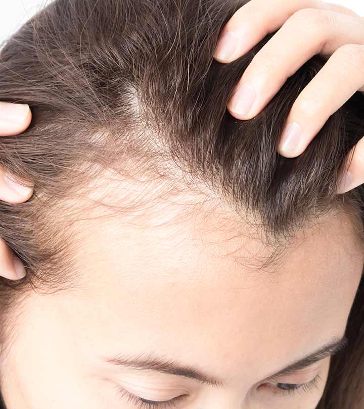 PRP Hair Loss Treatment in Kukatpally Hyderabad - Hair Growth