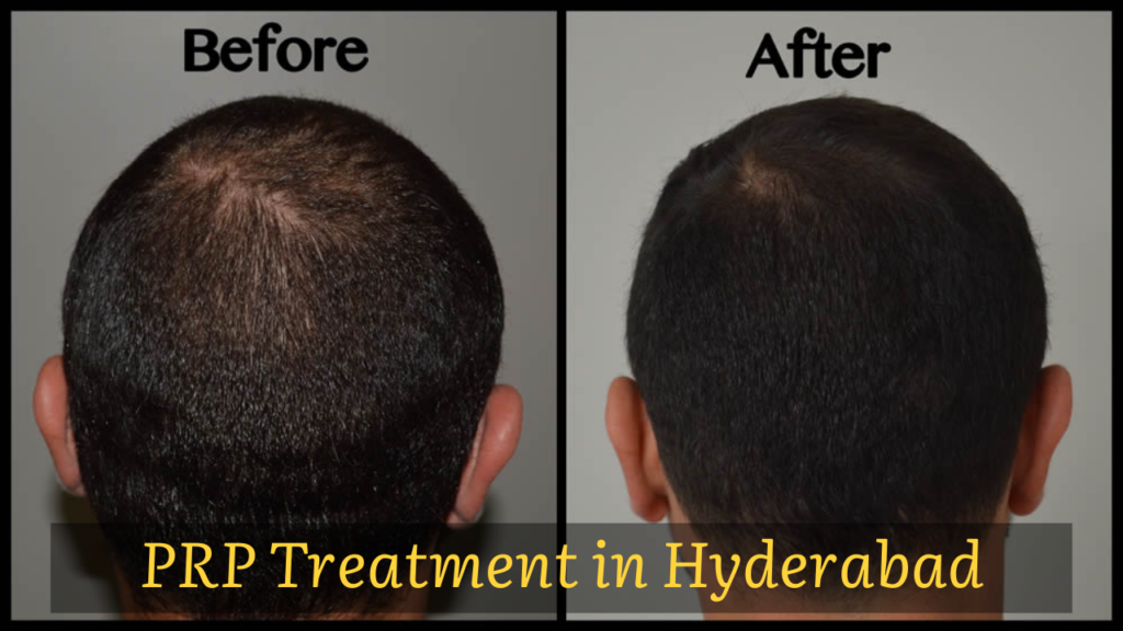 PRP Hair Loss Treatment in Hyderabad