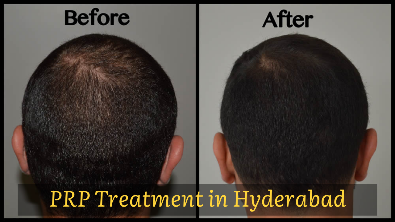 PRP Hair Loss Treatment in Hyderabad