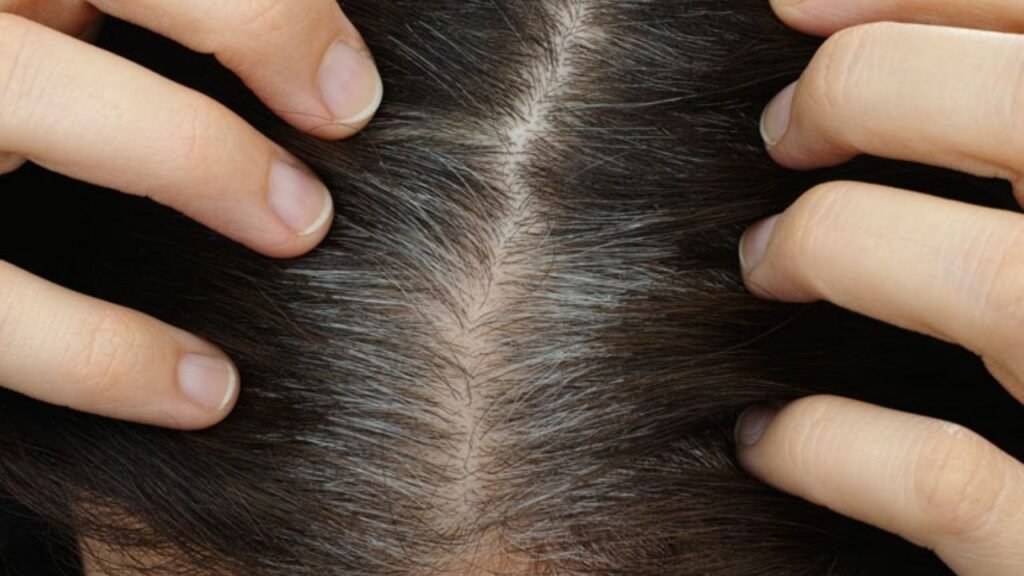 Scalp Folliculitis