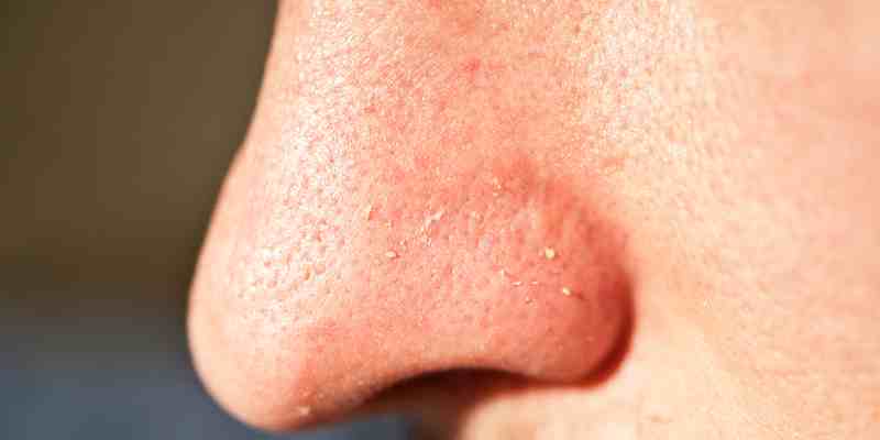 How To Get Rid Of Clogged Pores From Face? What Causes Clogged Pores On Face?