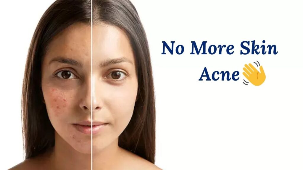 Nodular Acne Treatment Options