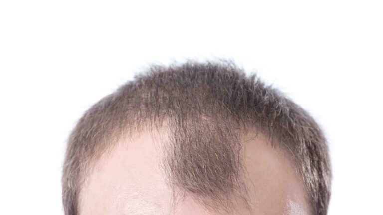 How to Stop Receding Hairline?