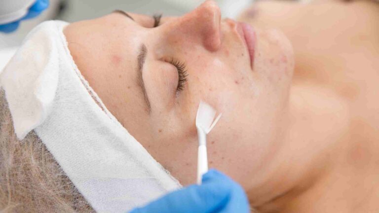 What Is Chemical Peel Treatment? How Much Does It Cost in India?