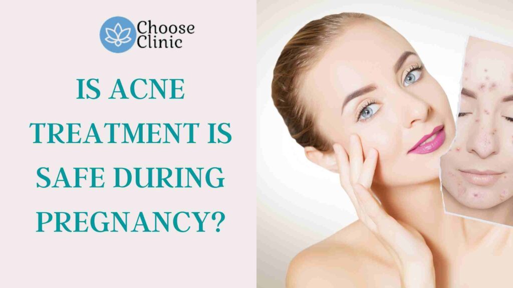 IS ACNE TREATMENT IS SAFE DURING PREGNANCY