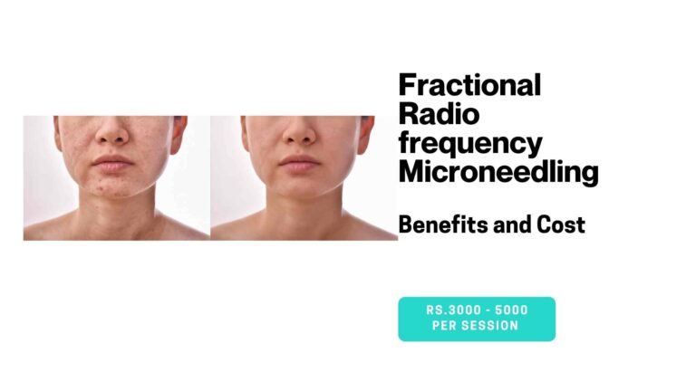 Fractional Radio frequency Microneedling: Benefits and Cost