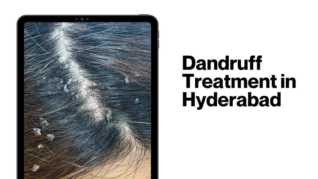 Dandruff Treatment in Hyderabad