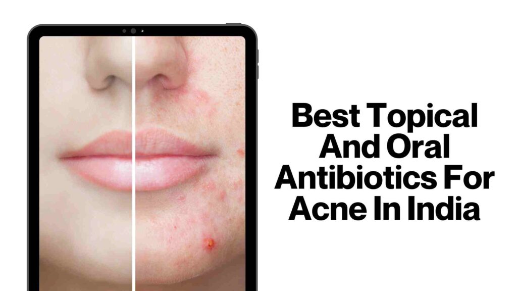 Topical And Oral Antibiotics For Acne