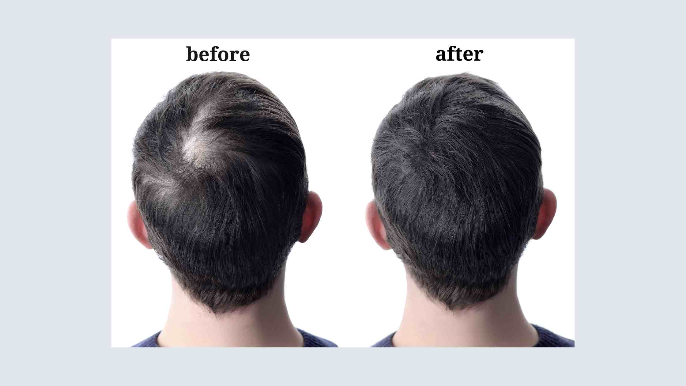 Hair Growth Treatment in Hyderabad