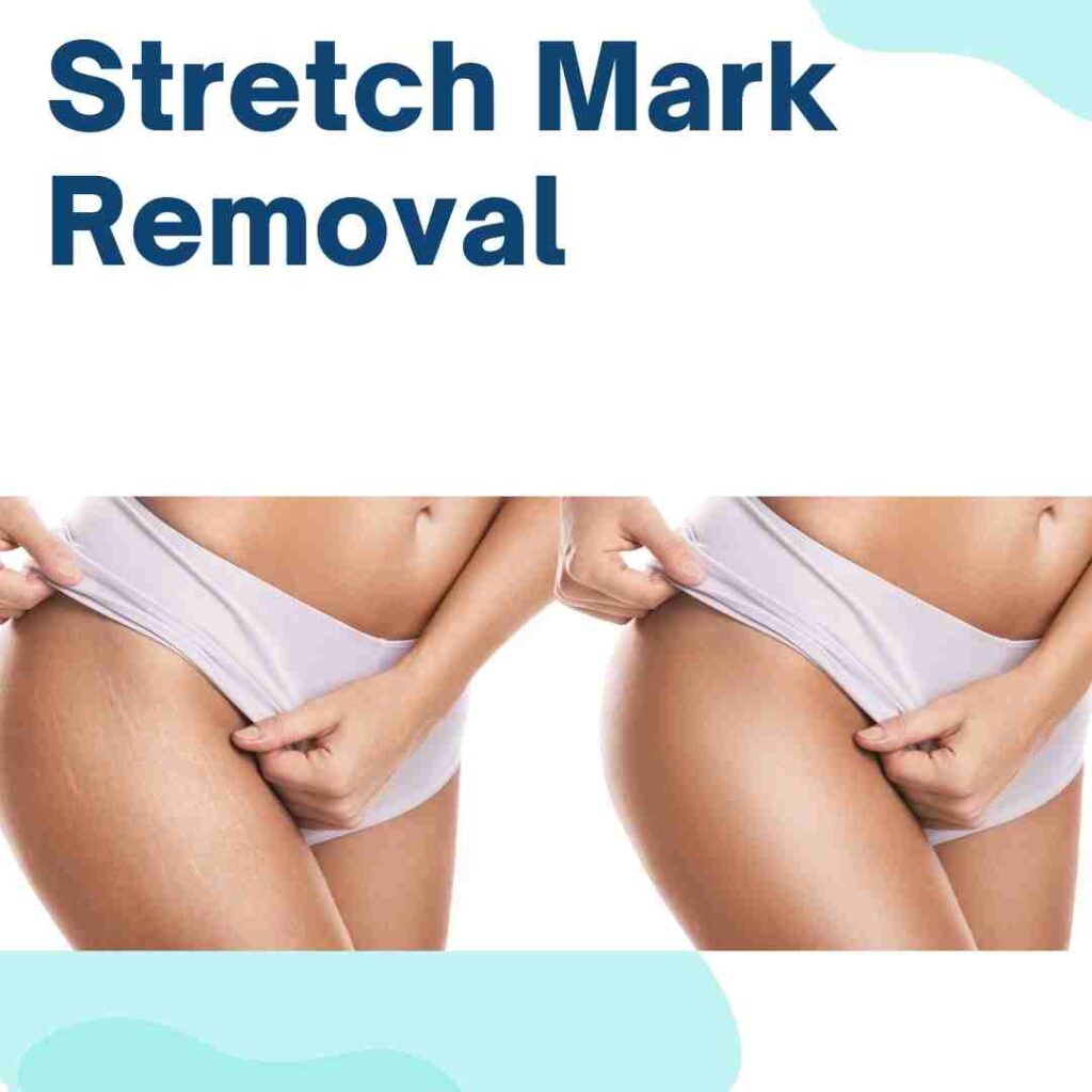 stretch Marks Removal Treatment