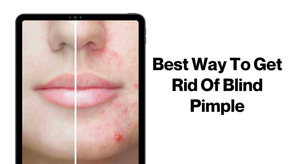 get rid of blind pimple