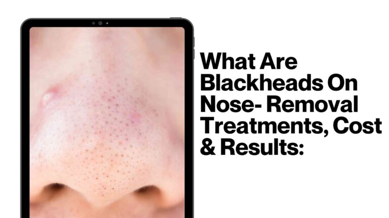 What Are Blackheads On Nose- Removal Treatments, Cost & Results: