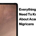 Everything You Need To Know About Acanthosis Nigricans