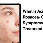 What Is Acne Rosacea- Causes, Symptoms, Treatment Options & More