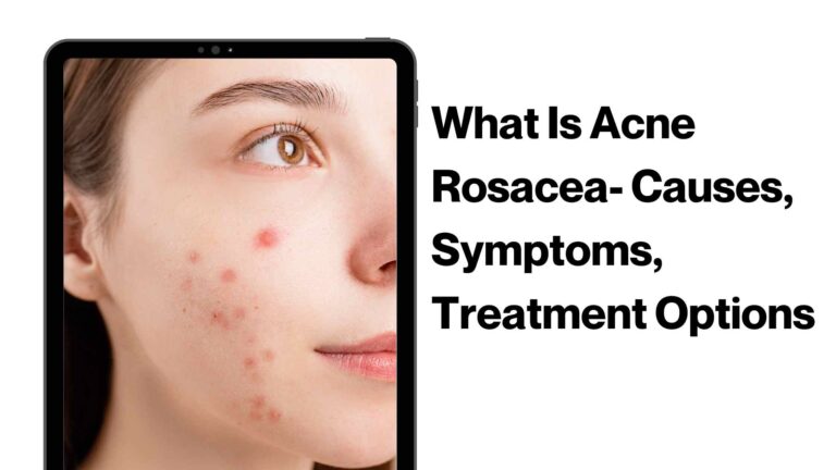 What Is Acne Rosacea- Causes, Symptoms, Treatment Options & More