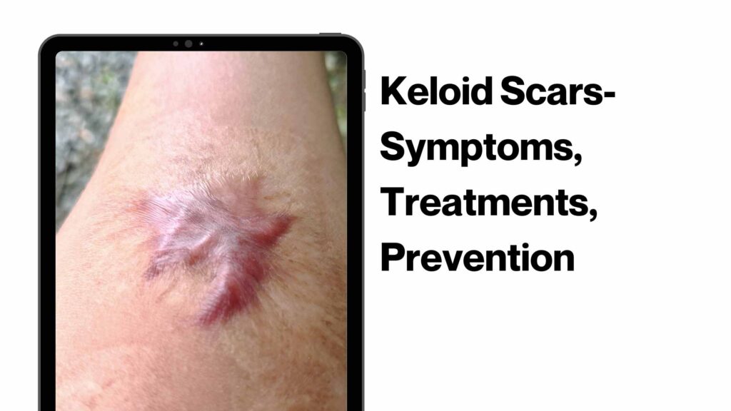 keloid scars treatment