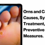 Orns and Calluses- Causes, Symptoms, Treatment, and Preventive Measures. 