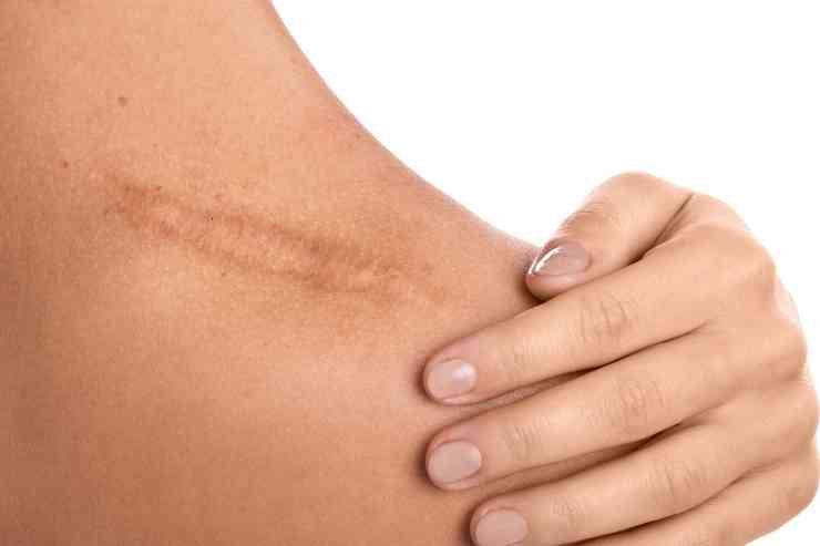 keloid scars,