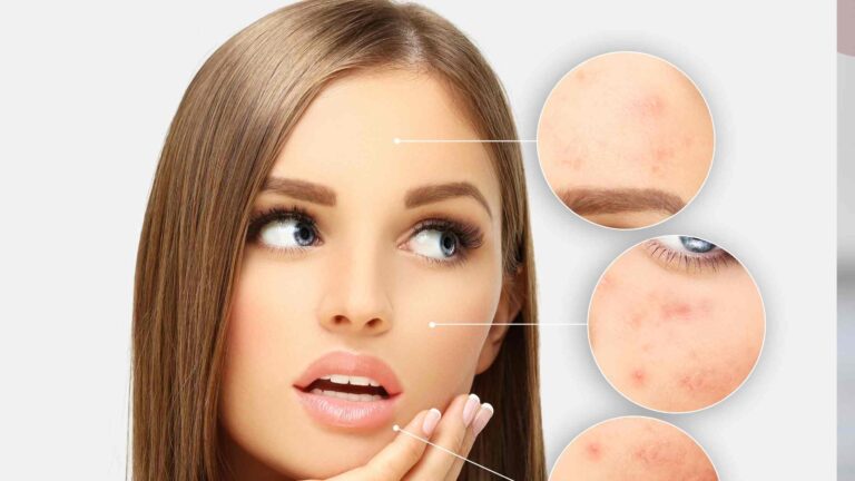 Laser Treatment for Acne Scars in Hyderabad- What Is Laser Treatment, and How Is It Done?