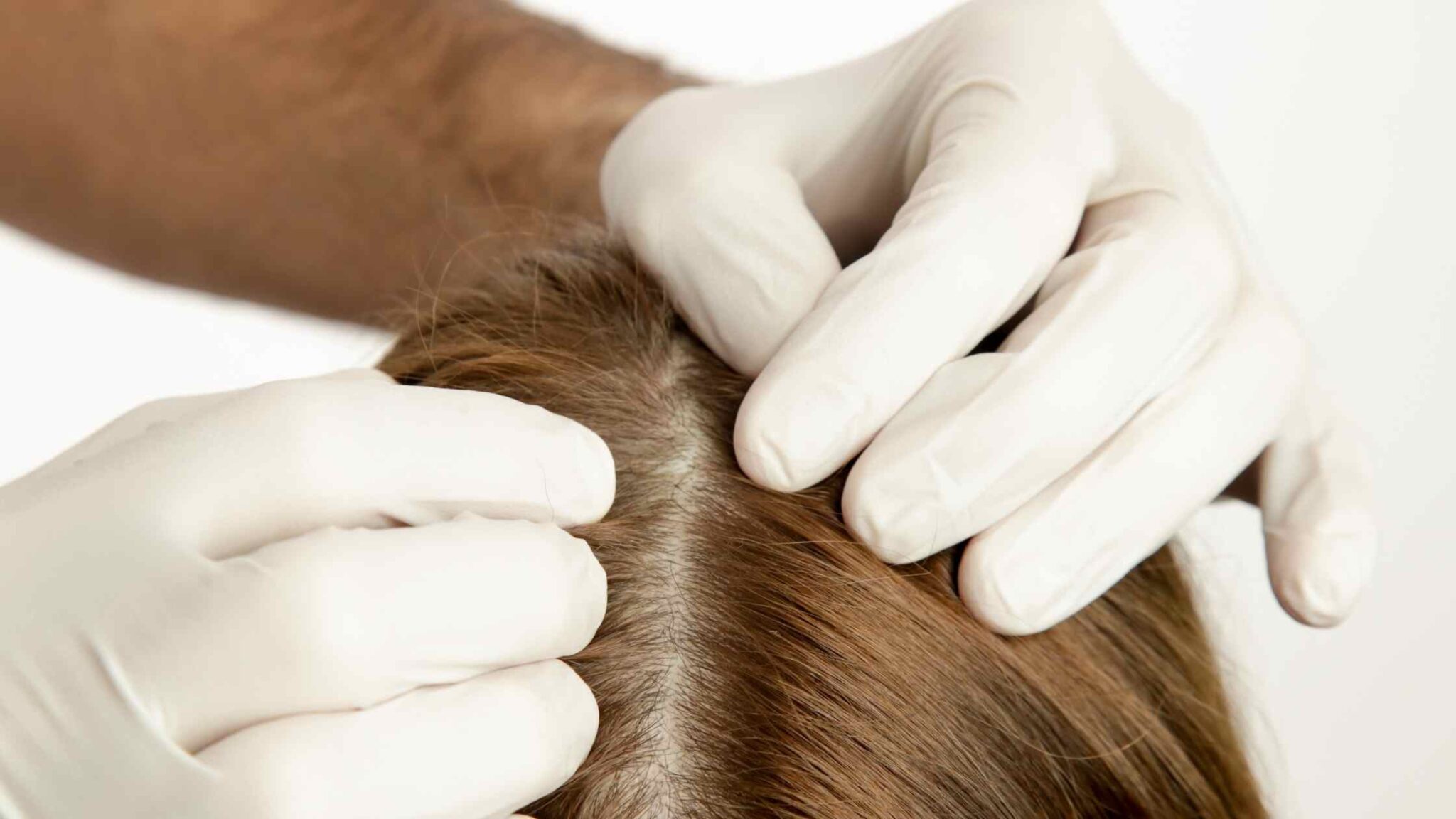 Scalp Folliculitis – Causes, Symptoms, Treatments, And Prevention