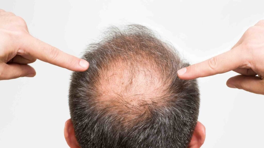 male pattern baldness