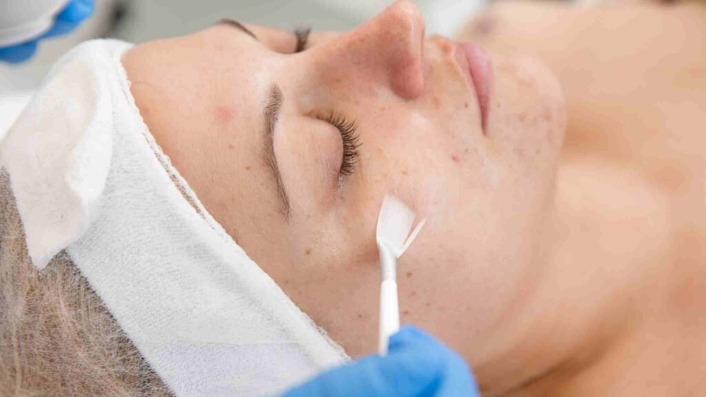 chemical peel treatment