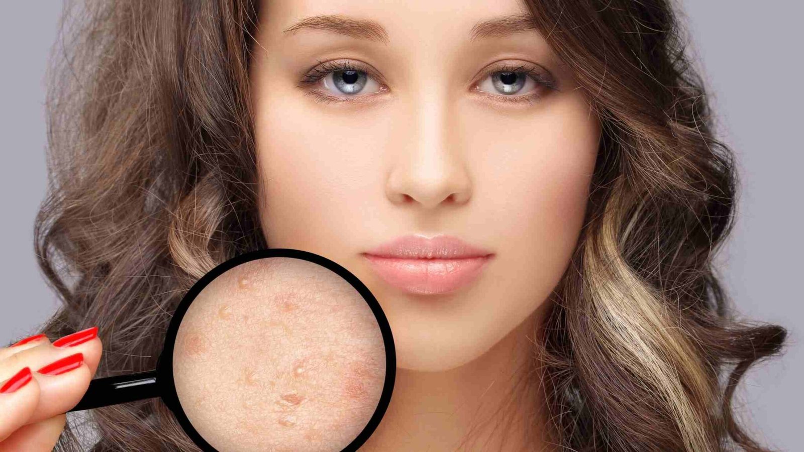 Acne Scar Treatment In Hyderabad Pimple Scar Treatment