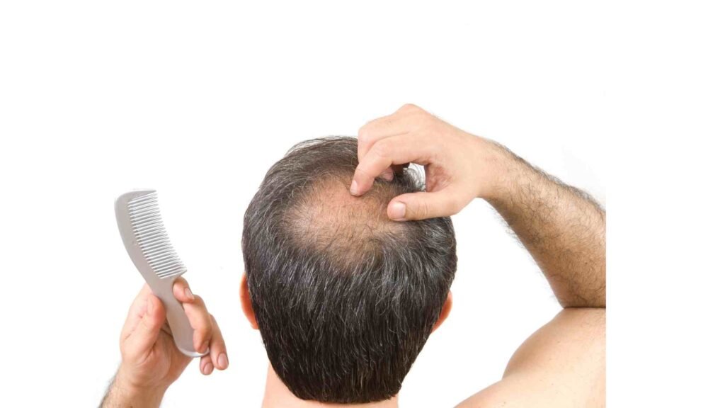 male pattern baldness