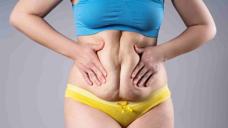 Tummy Weight Loss Treatment in Hyderabad