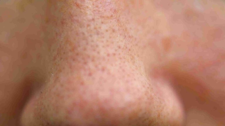 What Are Open Pores, and How to Treat Open Pores?