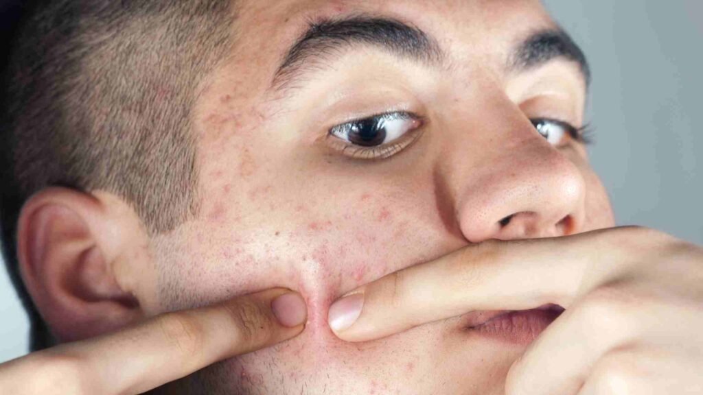 blind pimples