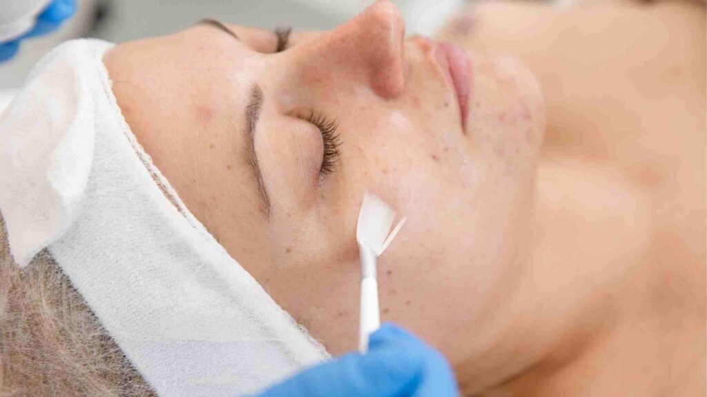  Chemical Peel 