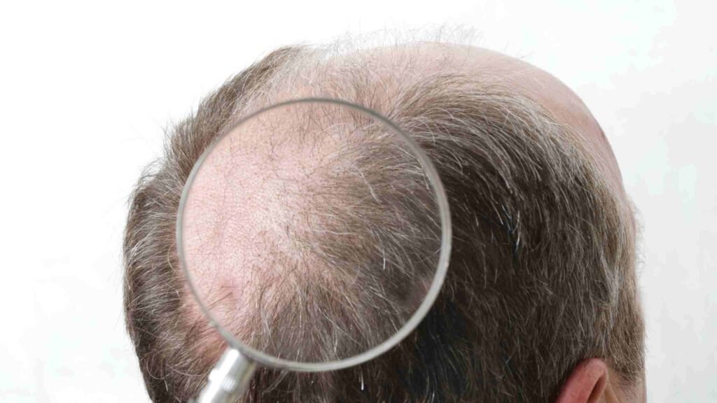 hair transplant