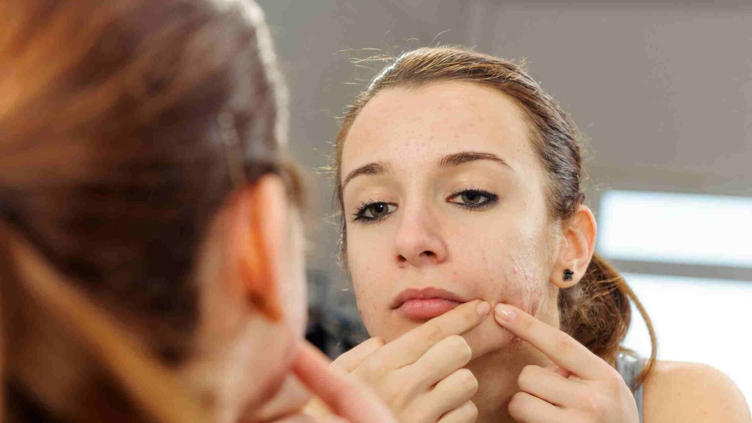 How To Reduce Body Heat Pimples