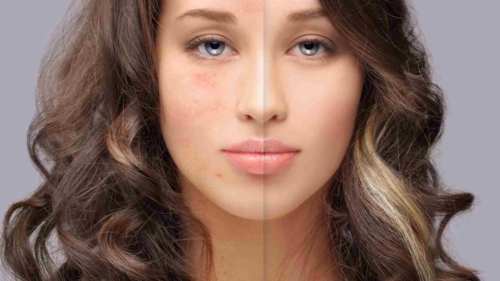 How To Reduce Body Heat Pimples